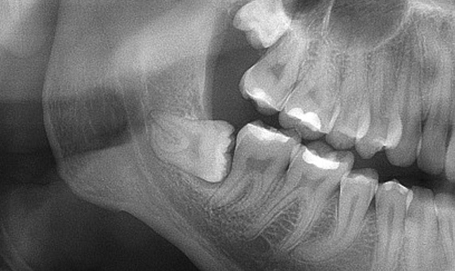 Recorte de una radiografía de la parte de las muelas donde se puede ver una muela del juicio en mala posición.